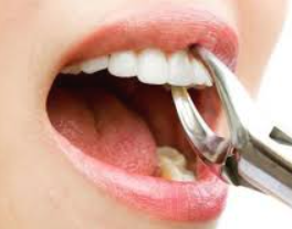 CABUT GIGI DENGAN PENYULIT